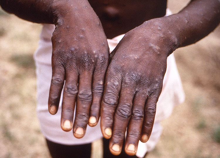 This 1997 photo depicts the hands of a patient with monkeypox, showing the characteristic rash of the infectious disease during its recovery stage.